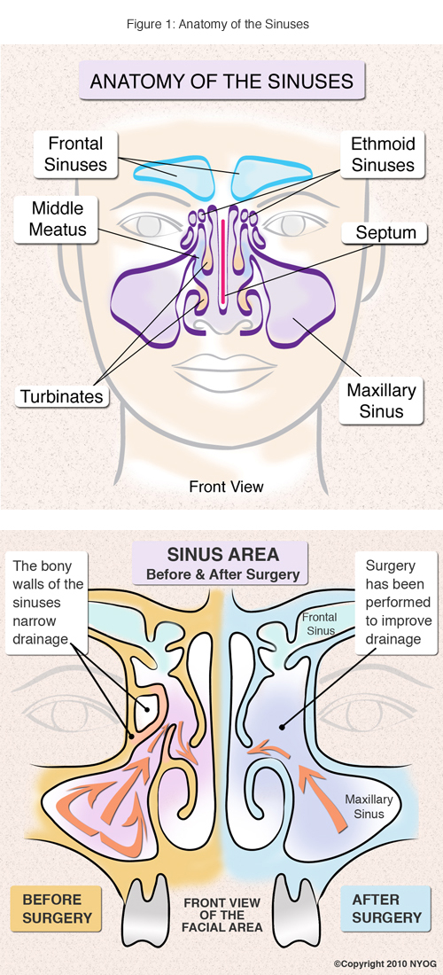 Understanding The Four Sinuses In Your Head